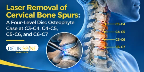 Illustration of cervical spine with highlighted disc osteophytes and labels, showing laser removal technique.