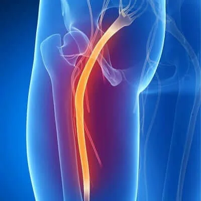 medical marijuana sciatica