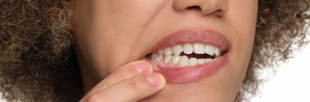 Person pulling down their lower lip to show teeth and gums.