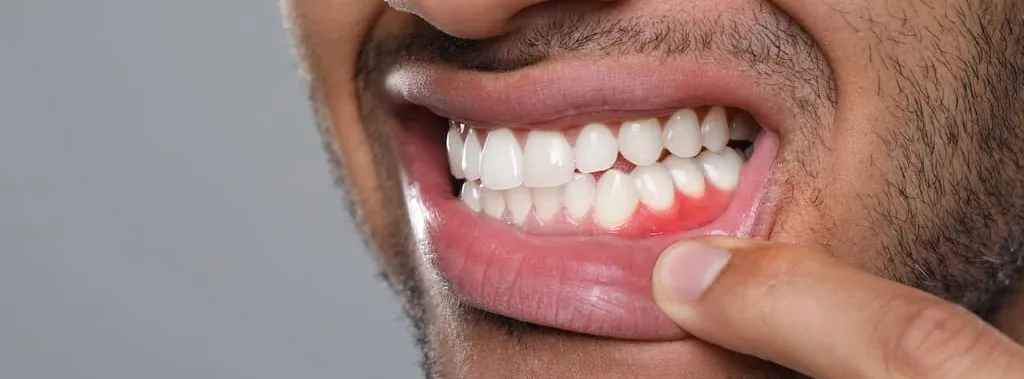 Gum disease treatment options