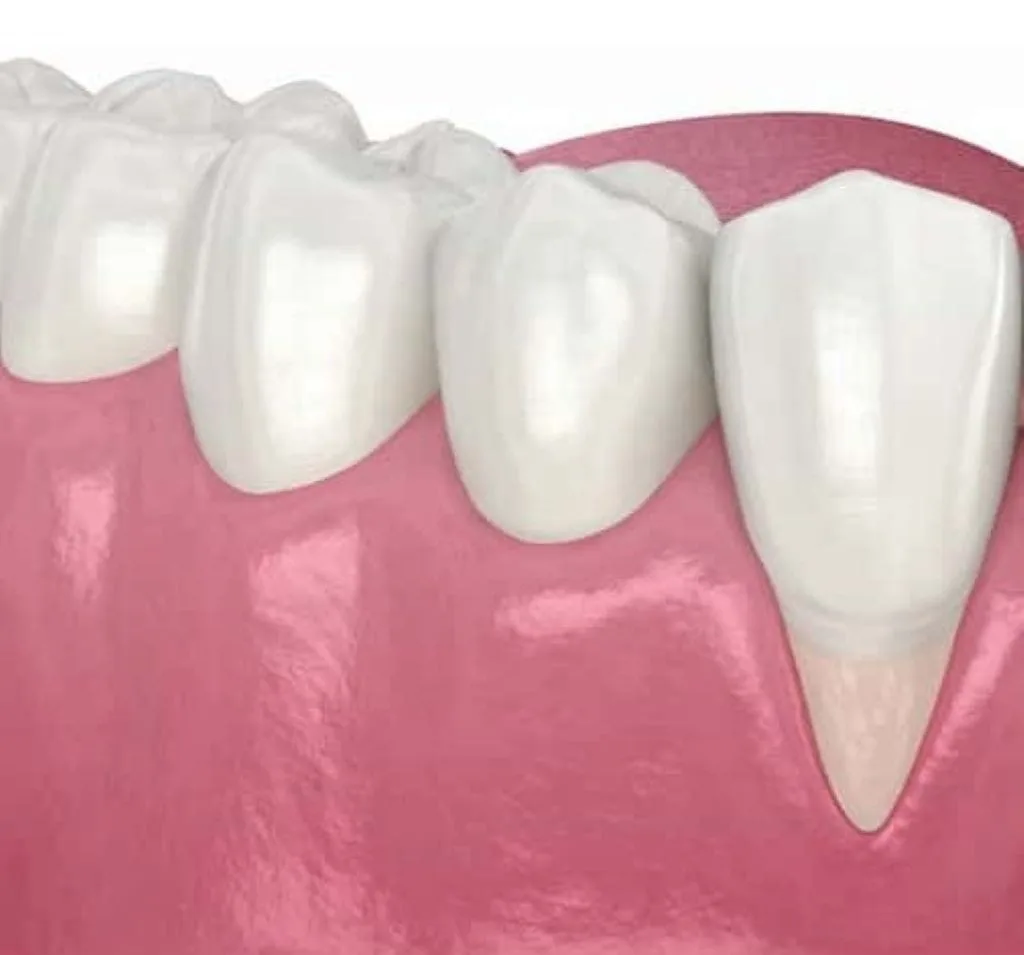 Gum Recession Signs: Recognizing the Early Warnings Your Mouth Is Sending