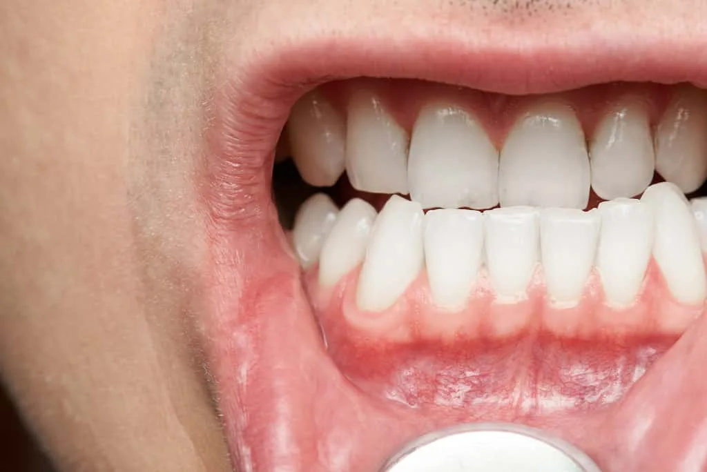 gum recession signs: recognizing the early warnings your mouth is sending 1 close-up of an open mouth showing clean, aligned teeth and gums.