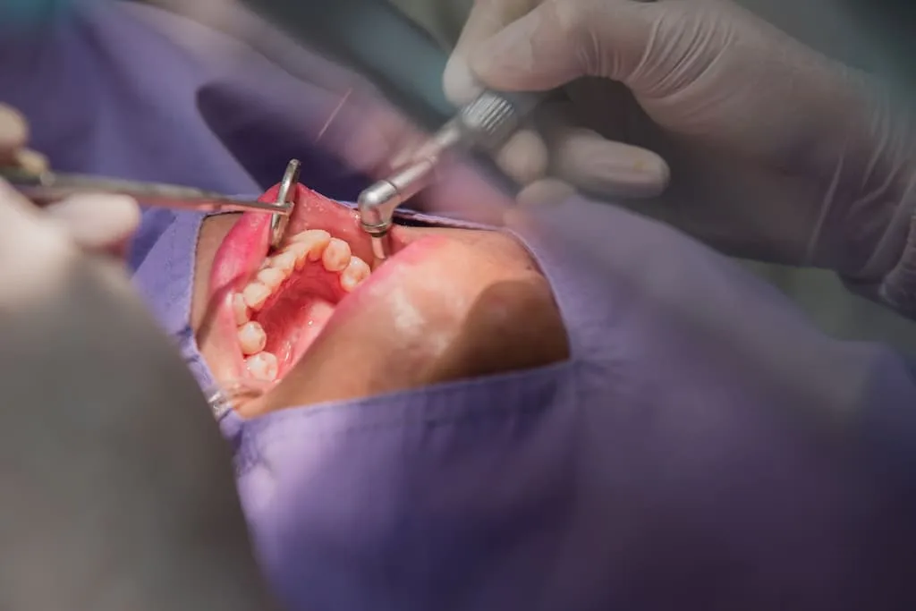 gum disease treatment options: deep cleaning vs. surgery 2 a dentist performs a procedure on a patient's open mouth.