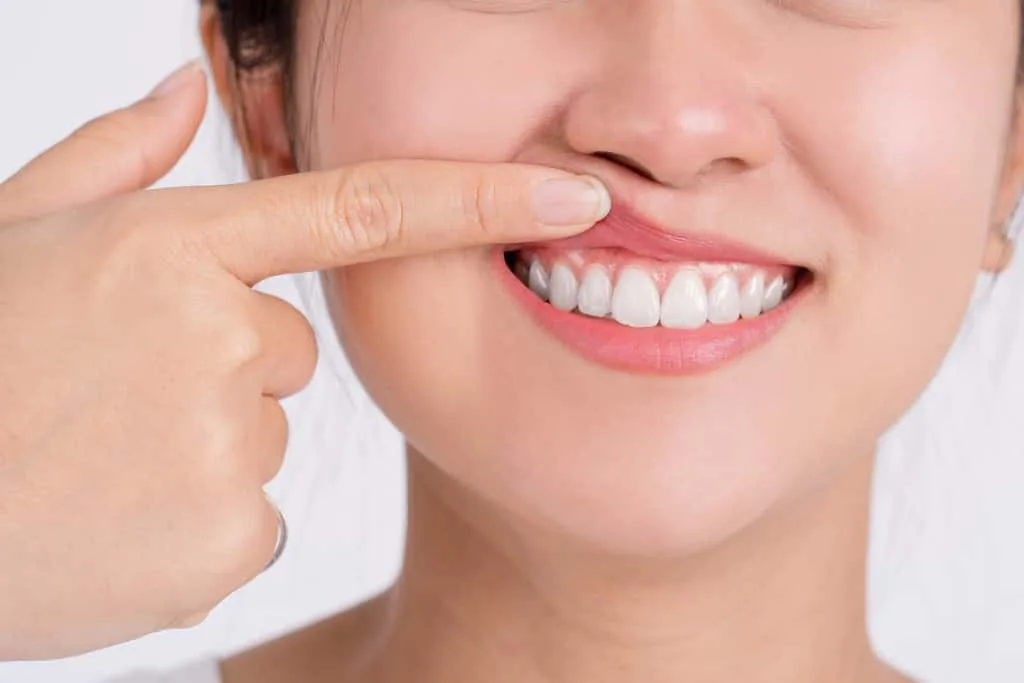person smiling, lifting their upper lip to show their teeth and gums.