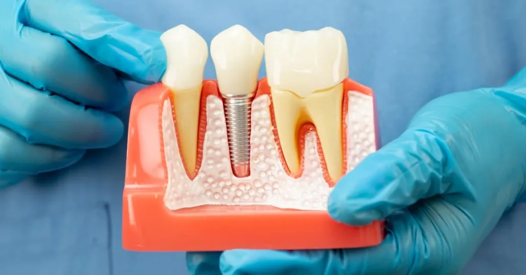 Full-arch implant
