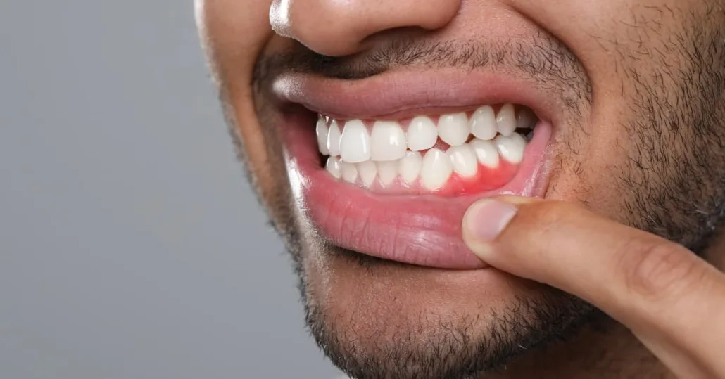gum disease prevention