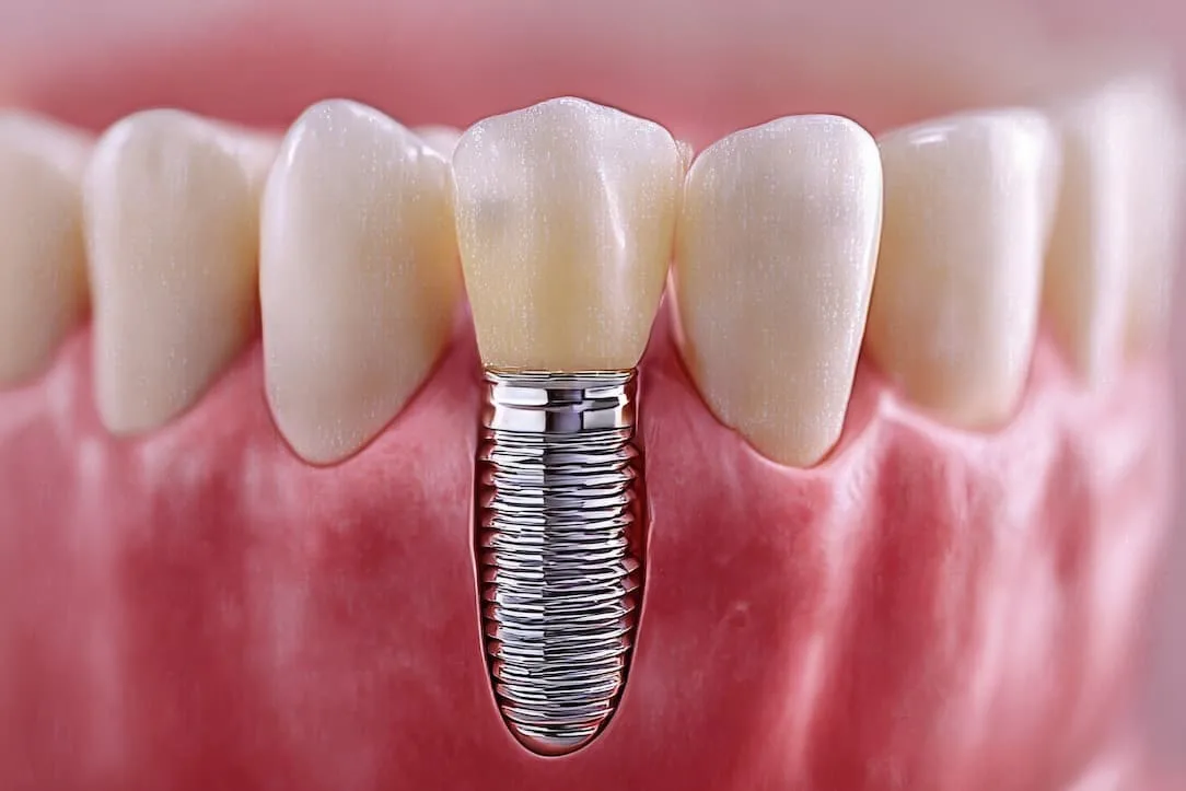 dental implant shown replacing a missing tooth in a row of teeth.