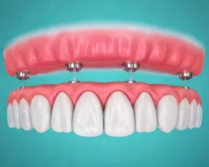 5 tooth replacement options: cost, comfort & longevity guide 5 illustration of dental implants supporting an upper denture with teeth.