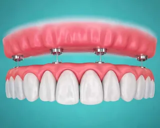 tooth replacement options compared by cost, lifespan and bone health 5 illustration of four implant posts set in an upper gum arch above a full row of replacement teeth