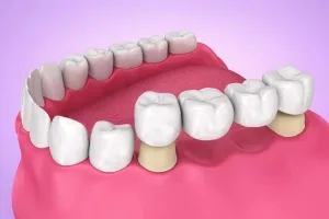 5 tooth replacement options: cost, comfort & longevity guide 2 illustration of a fixed dental bridge replacing missing molar teeth in a human lower jaw.