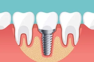 5 tooth replacement options: cost, comfort & longevity guide 3 illustration of a dental implant with a crown set between natural teeth in gum and bone.