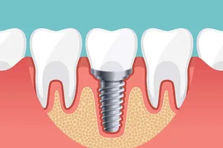 tooth replacement options compared by cost, lifespan and bone health 3 illustration of a dental implant post with a crown set in the jaw bone between natural teeth