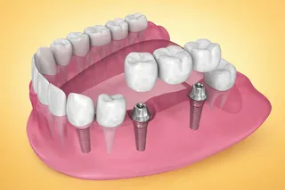 tooth replacement options compared by cost, lifespan and bone health 4 model of a dental bridge on two implants in a lower jaw beside natural teeth