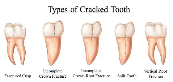types of cracked toth