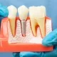 full-arch implants: complete guide to all-on-x and stabili systems 1 full-arch implant