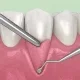 gum graft recovery