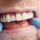 gum grafting: restoring health and confidence when your gums recede 2 gum grafting: restoring health and confidence when your gums recede