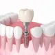 dental implant vs bridge: which one should you choose? 8 dental implant vs bridge