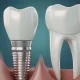 single-tooth denture vs implant: which option actually makes sense for you 1 single-tooth denture vs implant