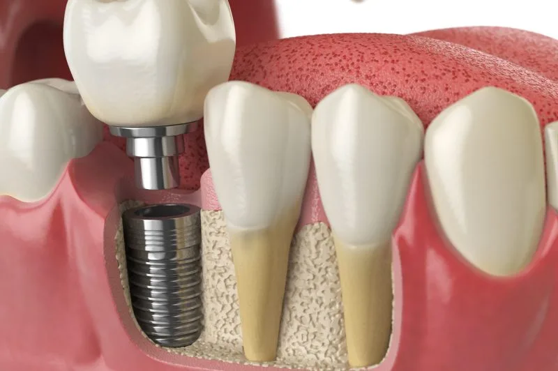 Anatomy of healthy teeth and tooth dental implant in human dentura. 3d illustration