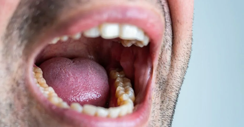 Roof of mouth hurts