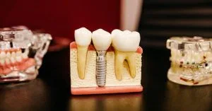 how long does a root canal take