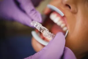 Comparing Invisalign vs Smile Direct