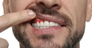 tingling gums