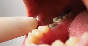 orange tooth decay treatments