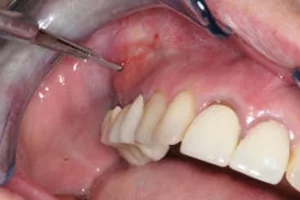 What Does a gum abscess look like?
