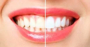 Professional teeth whitening in Mississauga