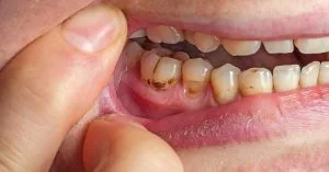 Understanding plaque vs tartar