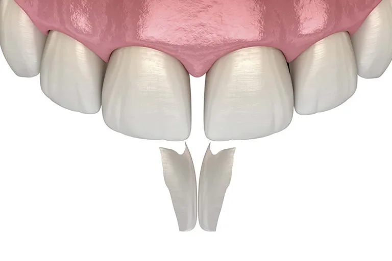 dental bonding